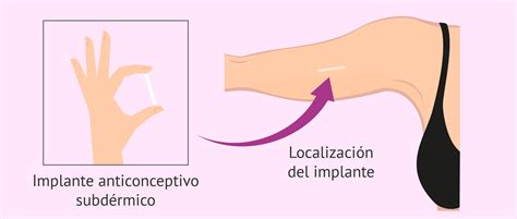 Anticonceptivos En El Brazo Que Tan Eficaz Y Seguro Es El Implante