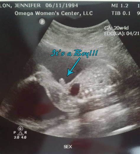 20 Weeks Ultrasound Girl