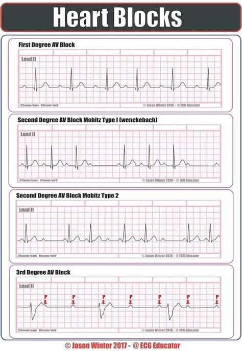 Ekg Practice Strips Printable - Printable Word Searches