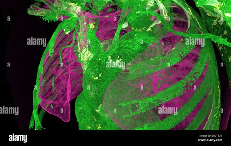 Bovine aortic arch variant, CT scan Stock Photo - Alamy