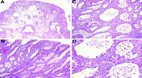 Gastric Polyps With Intramucosal Carcinoma Ajsp Reviews Reports