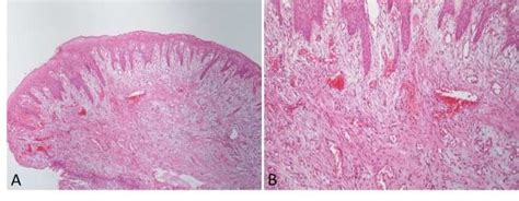 Histopathological Features Of Pyogenic Granuloma A And B