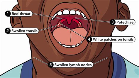 Is Strep Throat A Contagious Disease Understanding Its Prevention Care