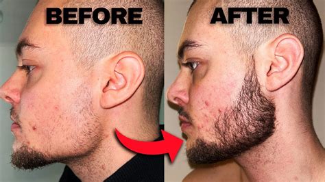 Minoxidil Beard Before And After 2 Months Progress Youtube