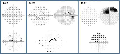 C Visual Field Testing Glaucoma Managements Paradigm Shift