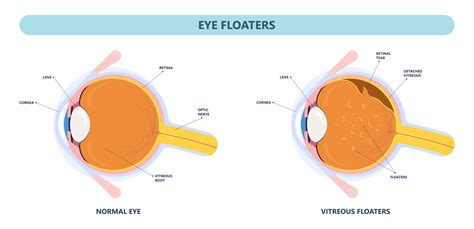 Retinal Tears And Holes Treatment Options Northeast Ohio Eye Surgeons