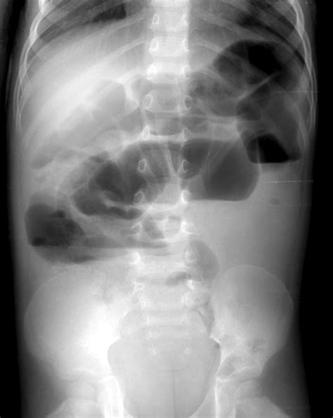 Adynamic Ileus With Gastroenteritis The Fluid Levels Tend To Be Long