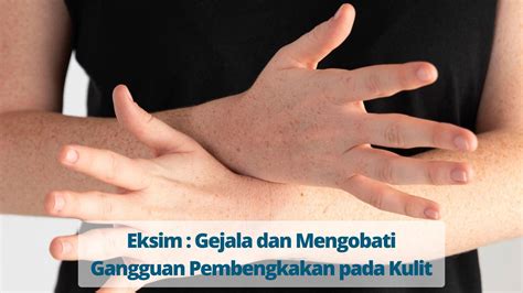 Eksim Gangguan Pembengkakan Pada Kulit Primaya Hospital