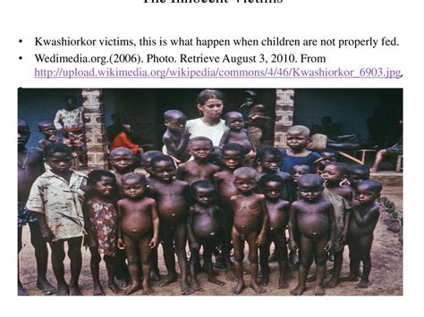 Kwashiorkor Kwashiorkor, A Forgotten Disease - ppt download