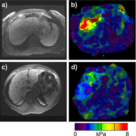 Evaluation Of Pretreatment Magnetic Resonance Elastography For The