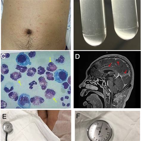 Clinical Features Of The Patient With Severe CNS Angiostrongyliasis A