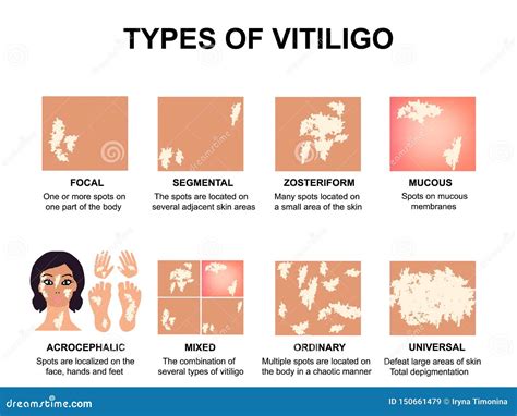 Types Of Vitiligo. World Vitiligo Day. Infographics. Vector ...