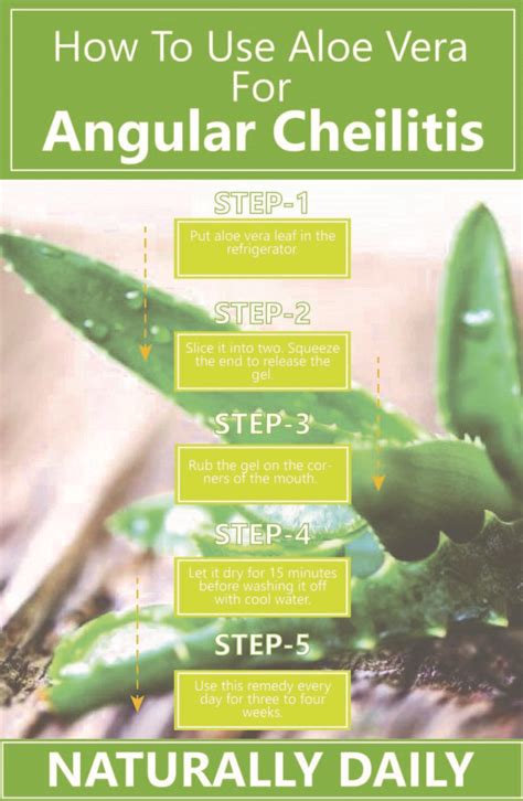 18 Quick Home Remedies for Angular Cheilitis - Naturally Daily