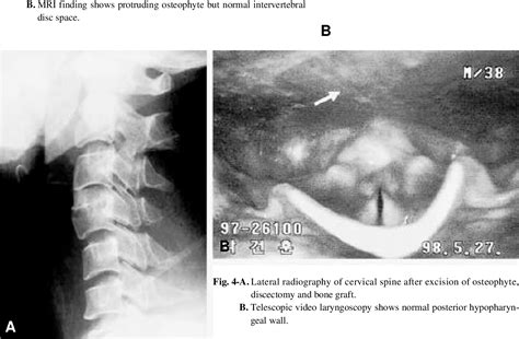 Figure 4 From Dysphagia Caused By An Anterior Cervical Osteophyte A Case Report Semantic