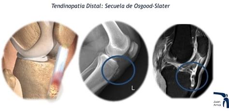 Lesion Del Tendon Rotuliano Tendinitis Rotuliana Juan Arnal