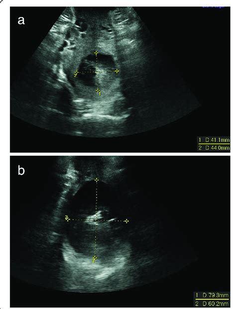 Transperineal 2d Ultrasound Measurement Of Cervical Dilatation At A Download Scientific