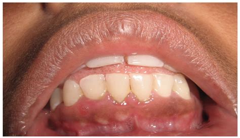 Ibima Publishing Gingival Fibrous Nodules Report Of Four Cases