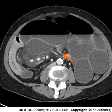 Computed Tomography Scan Showed A Dilated Small Bowel And Misty