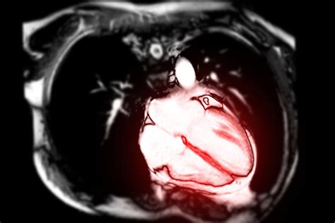 Cardiac MRI | What to Expect with a Heart MRI | Capital Area Cardiovascular Associates