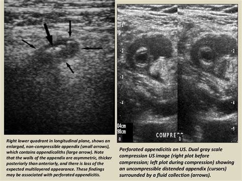 Presentation1.pptx, ultrasound examination of the appendix.