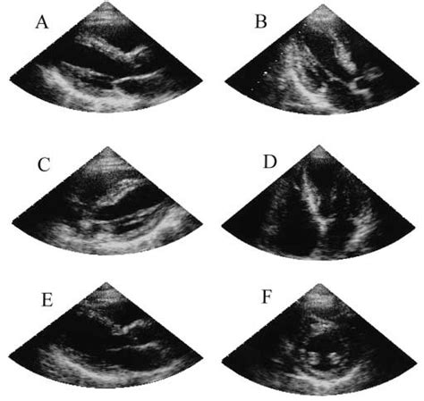 Representative Two Dimensional Echocardiographic Images Of The Heart In