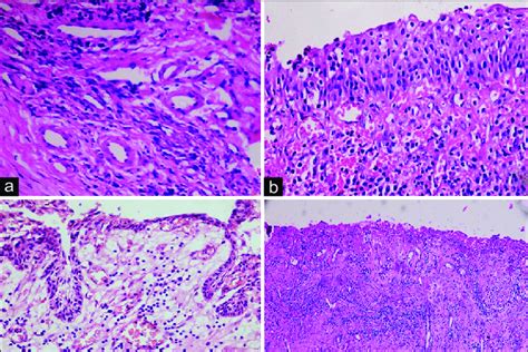 A Periapical Granuloma With Dense Chronic Inflammation H E 10x B