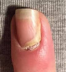 Onychomadesis Is The Separation And Falling Off Of A Nail Plate From