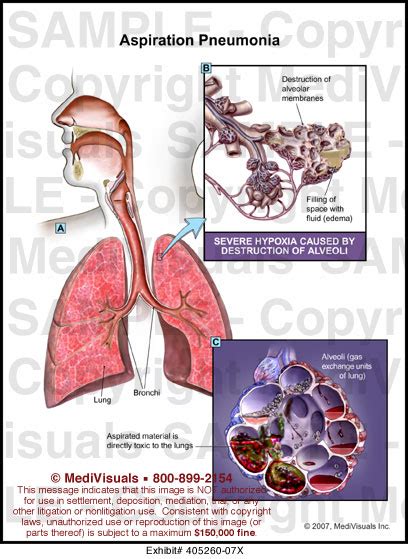 Medivisuals Aspiration Pneumonia Medical Illustration