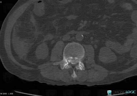 Radiology case : Gout (MRI ,CT) - Diagnologic