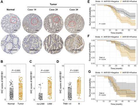 Aberrant Expression Of AKR1B1 Indicates Poor Prognosis And Promotes