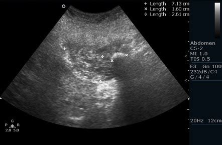 Gallbladder Carcinoma Radiology Case Radiopaedia Org