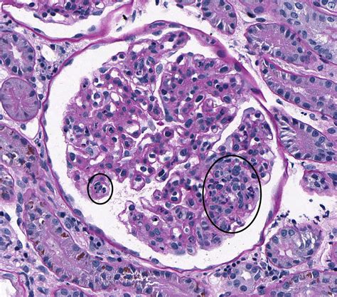 Membranoproliferative Glomerulonephritis Type 1