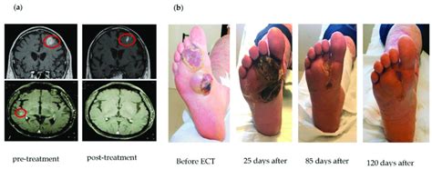 Representative Cases Of Patients Treated With Different Loco Regional