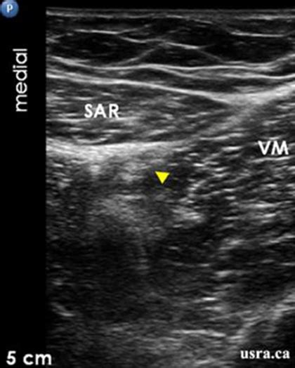 Usra Saphenous Nerve Block