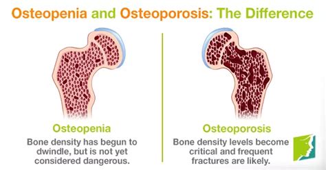 Osteopenia And Osteoporosis Ace Health Centre