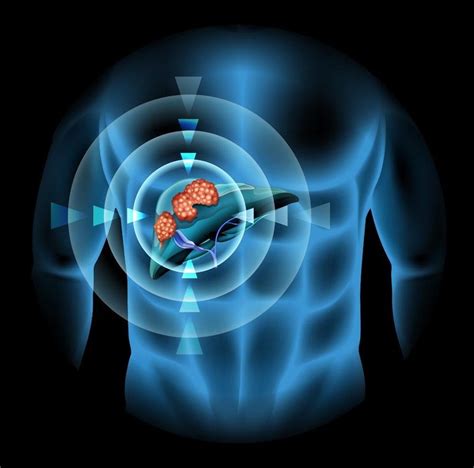 A New Trial Uses Heat Sensitive Cancer Drugs To Target Tumors Directly