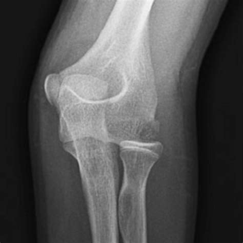 X Ray Left Elbow Joint Ap Lateral Test Price In Delhi Ganesh Diagnostic