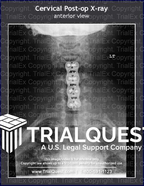 Cervical Post Op X Ray Trial Exhibits Inc