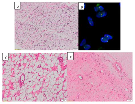 A Mlps Myxoid Liposarcoma Before Treatment Paucicellular