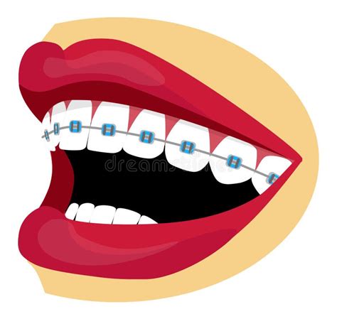 Braces Illustration Stock Vector Illustration Of Braces 34156066