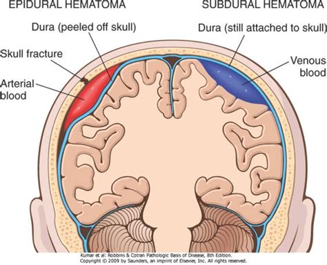 Epidural Vs Subdural Hematoma Epidural Space Contains Meningeal