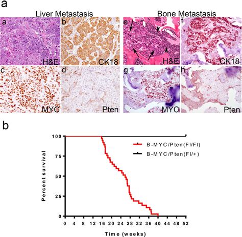 Myc Expression Combined With Pten Loss Leads To Metastatic