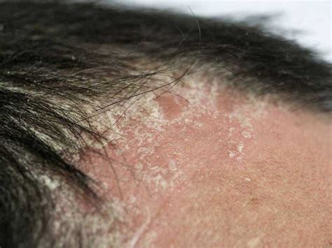 Warning: These 5 Finasteride Side Effects Might Destroy Your Body