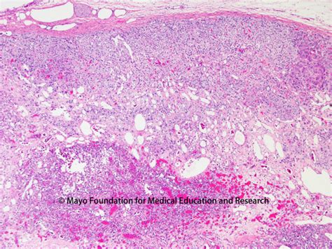 Anastomosing Hemangioma Of The Adrenal Gland Mayo Clinic Proceedings