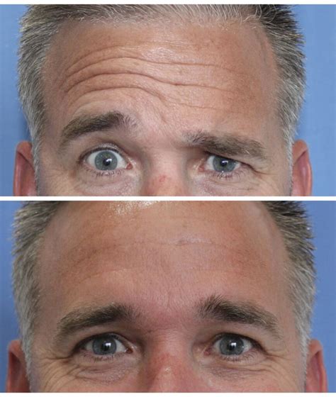 Botox For Men Modern Aesthetic Centers Gate Parkway