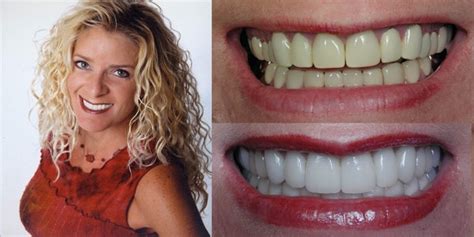 Porcelain Veneers Straighten Teeth Faster With Instant Orthodontics