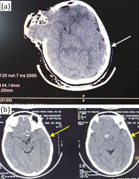 A Computed Tomography Ct Scan Showing Right Pterional Craniotomy