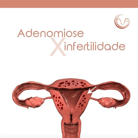 Adenomiose E Infertilidade