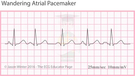 Ecg Educator Blog Atrial Rhythms
