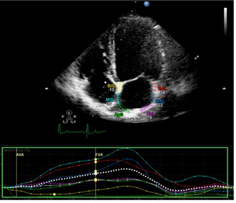 Left Atrial Strain Obtained By Twodimensional Speckle Tracking In This